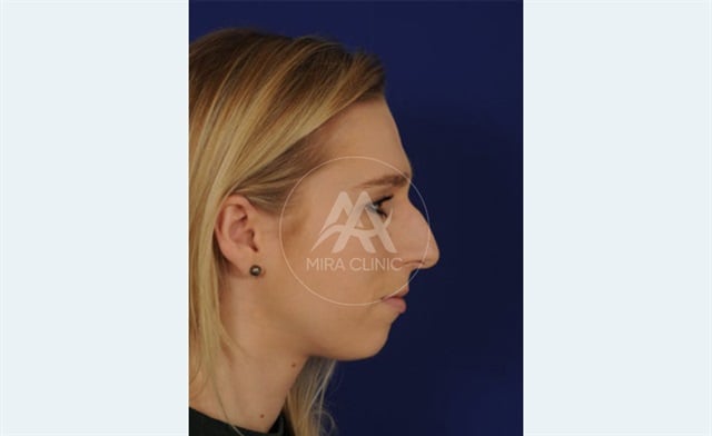Before & After Rhinoplasty 