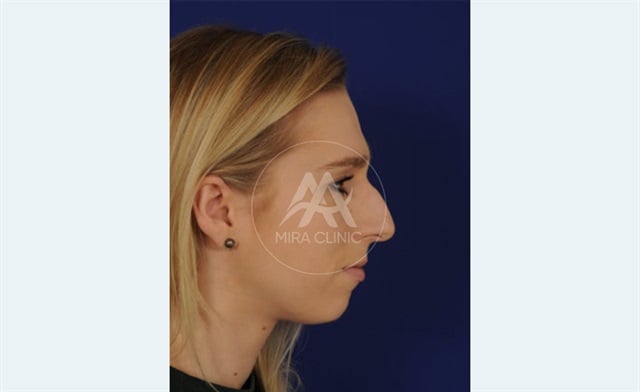 Avant après Rhinoplastie 