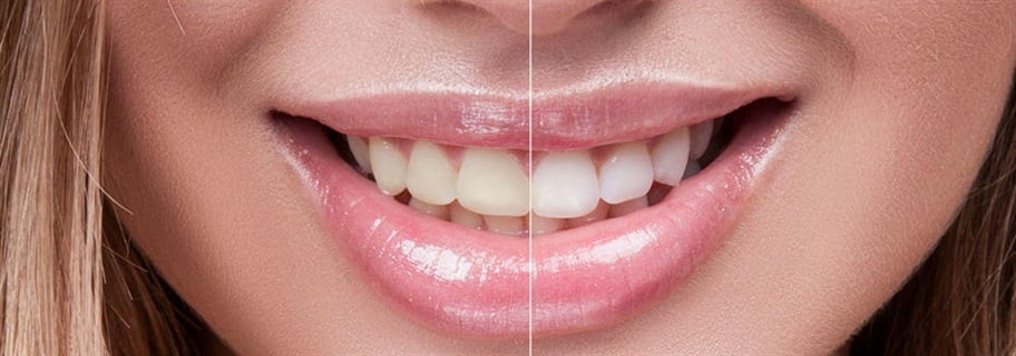 The Cost of Cosmetic Dentistry in Turkey 2024