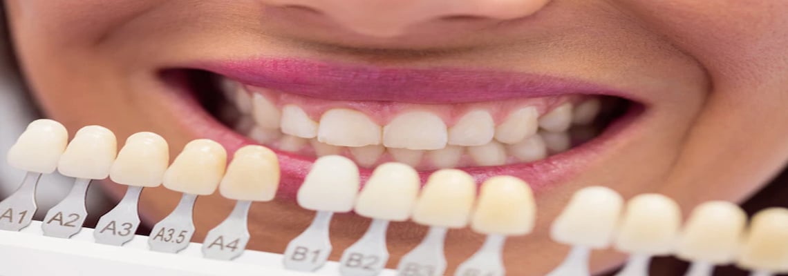 Dental veneers FAQs