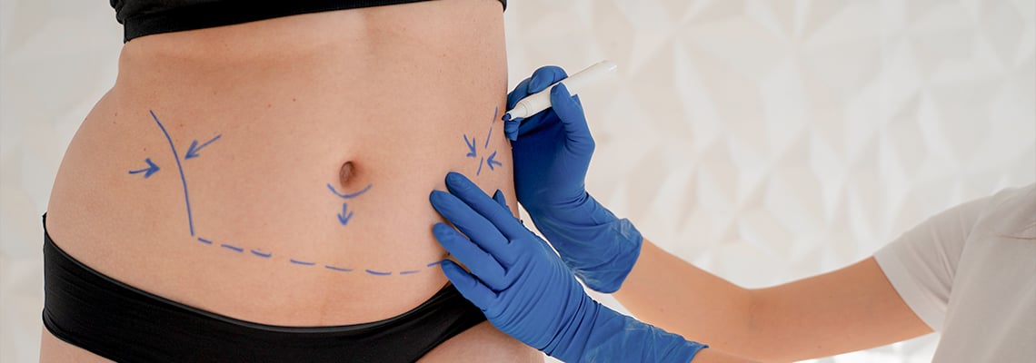 Comment faire une abdominoplastie et une liposuccion ensemble?