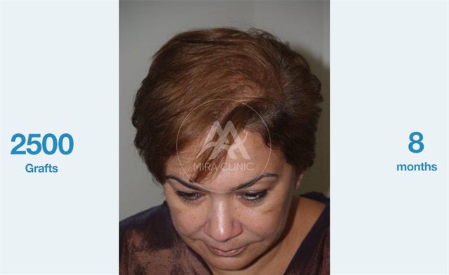 Before & After Hair transplantation for women