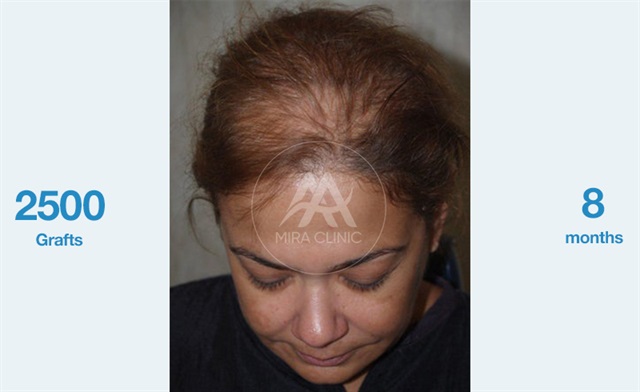 Before & After Hair transplantation for women 